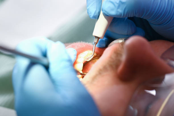 Best Emergency Tooth Extraction in Hydesville, CA